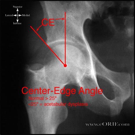 Acetabular Dysplasia Q65.8 | eORIF