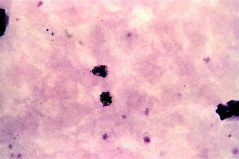 Malaria Smear Stain