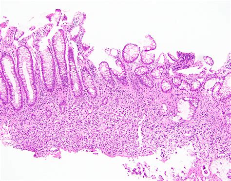 Ügyetlen levelet írni Valójában signet ring cell carcinoma colon bors Virágzás Gyengéd