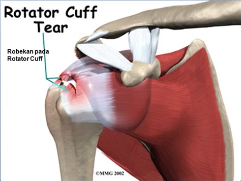 Rotator Cuff Tendinitis | Singapore Sports & Orthopaedic Surgeon