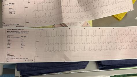 SVT and the work of adenosine : r/ECG