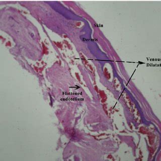 (PDF) Blue Rubber Bleb Nevus Syndrome: Successful Treatment With Sirolimus