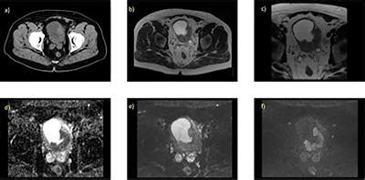 Frontiers | MR-Guided Adaptive Radiotherapy for Bladder Cancer