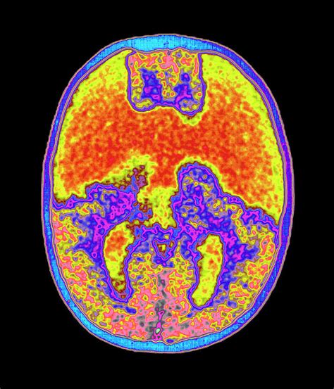 Coloured Mri Brain Scan Showing Holoprosencephaly Photograph by Mehau ...