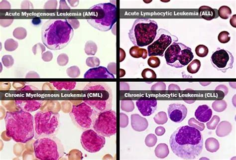 What Are the Types of Leukemia? — Medipulse: Best Private Hospital in Jodhpur