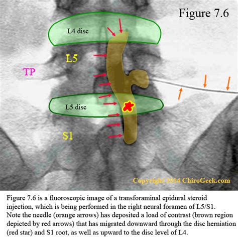 Epidural Steroid Injections