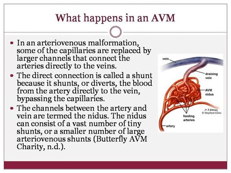 107 best AVM images on Pinterest | Brain aneurysm, Brain health and ...