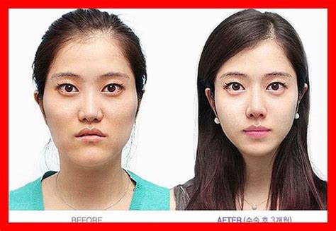 Before and After Photos of Korean Plastic Surgery. Part 2 (62 PICS) - Izismile.com