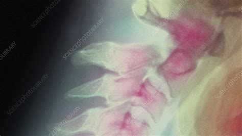 Broken neck, X-ray - Stock Video Clip - K012/2677 - Science Photo Library