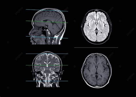 Comparison Of Brain Mri In Axial Coronal And Sagittal Planes Photo ...