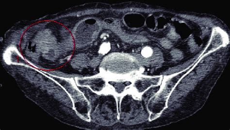 Contrast-enhanced CT scan of abdomen showed 31 x 23 mm lesion in right... | Download Scientific ...