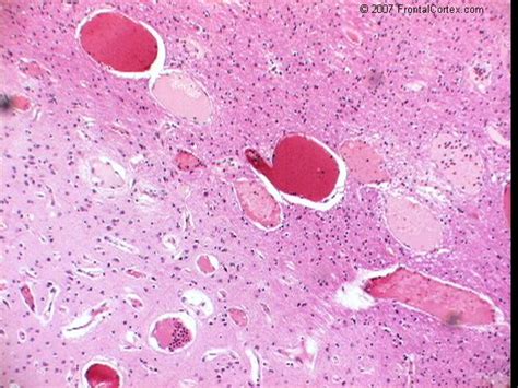 Image: Capillary Telangiectases