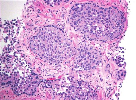 Prostate needle biopsy with distended ducts filled with atypical cells ...