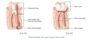 Root Canal Retreatment | Twin City Dental