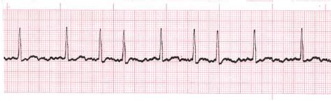 Atrial Fibrillation: The Pharmacist's Survival Guide — tl;dr pharmacy