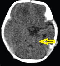 Kernohan’s notch: Uncal Herniation - Sumer's Radiology Blog