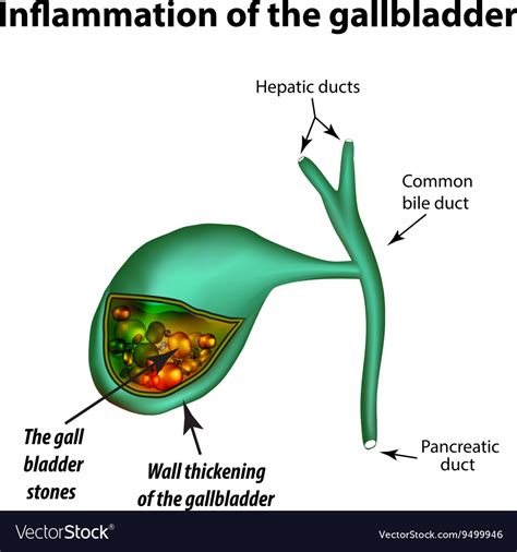 Gallstones cholelithiasis cholecystitis Royalty Free Vector