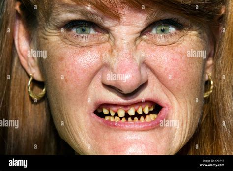 Mature woman whose teeth have be ground down in preparation for Stock ...