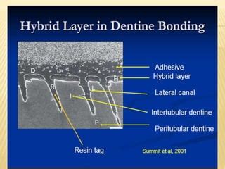 Dentin bonding | PPT