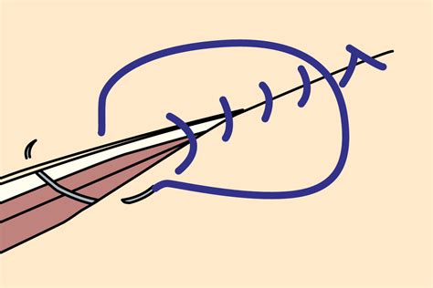 Common Suture Patterns and Suture Techniques - EndoGynecology