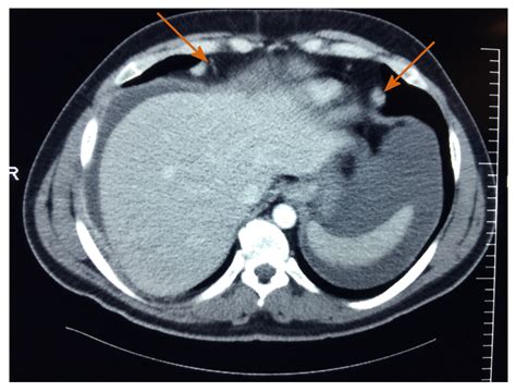 Bts Mesothelioma Guidelines 2018