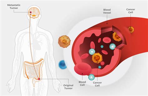 Metastatic Colorectal Cancer May Spread Early - NCI