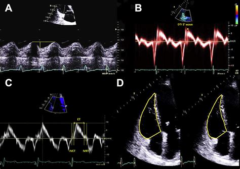 Role of Two-Dimensional Speckle-Tracking Echocardiography Strain in the ...