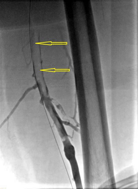 Intravascular ultrasound-guided mechanical thrombectomy using the INARI ...