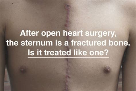 After open heart surgery, the sternum is a fractured bone. Is it treat - Qualiteam.com