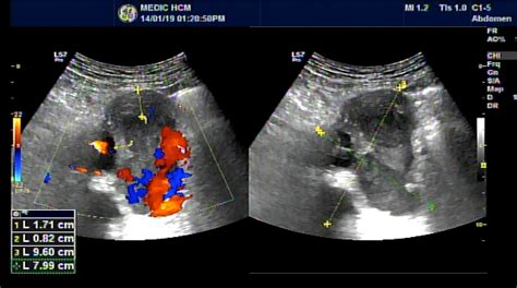 VIETNAMESE MEDIC ULTRASOUND: CASE 533: RETROPERITONEAL HEMATOMA, Dr PHAN THANH HAI, MEDIC ...