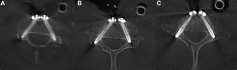 Intraoperative imaging of O-arm system verification (a) C4, (b) C6, and ...