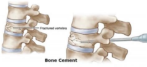 What is Bone Cement Implantation Syndrome? | Dataintelo