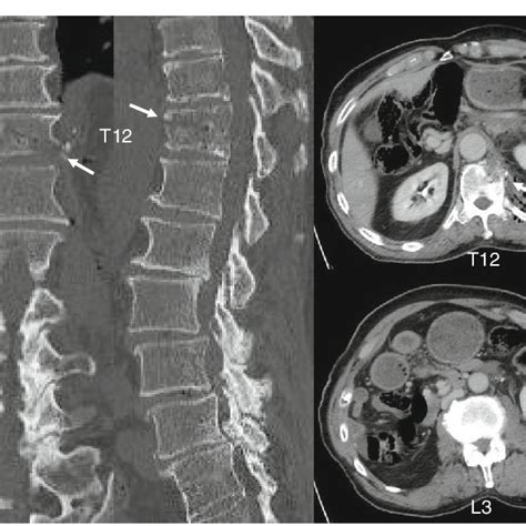 (PDF) Aspergillus terreus spondylodiscitis following an abdominal stab ...