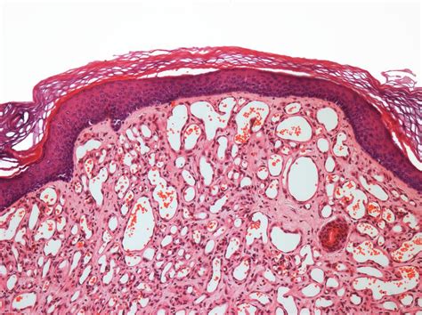 Capillary Hemangioma Photograph by Steve Gschmeissner/science Photo ...