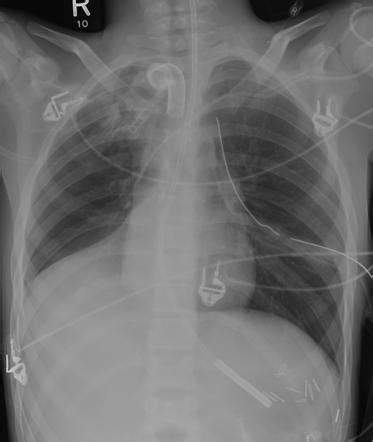 Right lower lobe collapse | Radiology Reference Article | Radiopaedia.org