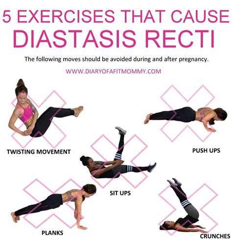 Can I Exercise With Diastasis Recti - Exercise Poster