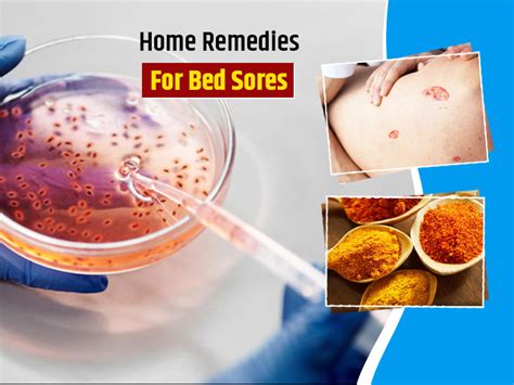 Bed Sores Remedies: Try These 6 Home Hacks For Relief | OnlyMyHealth