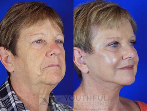 CO2 Laser Skin Resurfacing Before & After Photos Patient 2 | Nashville ...