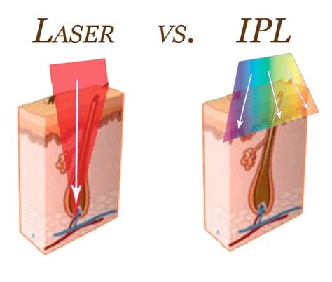 Laser vs Intense Pulsed Light (IPL) | Best Plastic & Cosmetic Surgery Clinic Dubai UAE