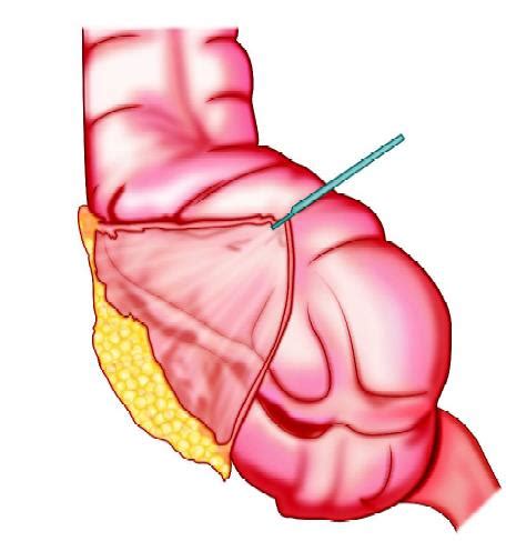 Operative Steps of Risk Factors and Complication of Laparoscopic Appendectomy