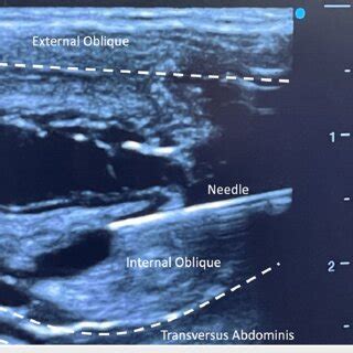 Shown is evidence of needle placement into the anterior abdominal wall ...