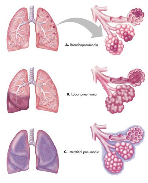 Types of pneumonia | Medical anatomy, Medical, Pharmacology nursing