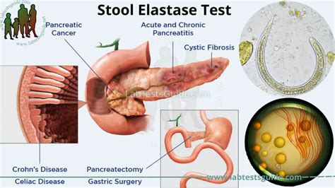 Stool Elastase Test: Purpose, Procedure, and Results - Everything You Need to Know