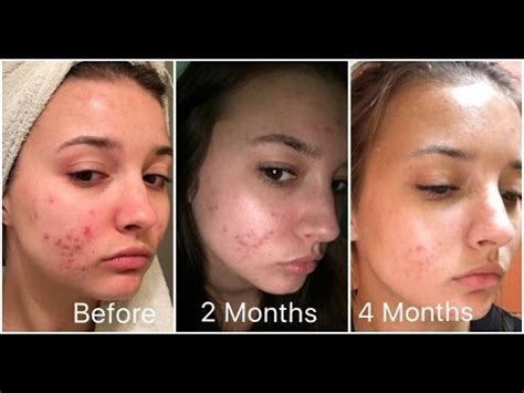 Retin-A 4 Month Skin Update (Acne) | jennybeYOUty - YouTube