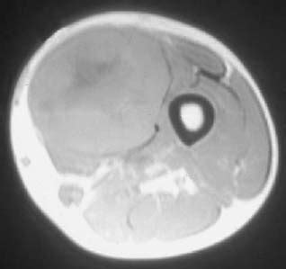 44 Malignant Fibrous Histiocytoma | Radiology Key