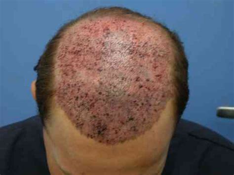 US Hair Transplant» Blog Archive » Bleeding After Hair Restoration ...