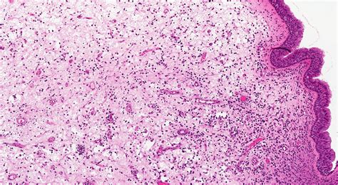 Nasal Polyps Histology