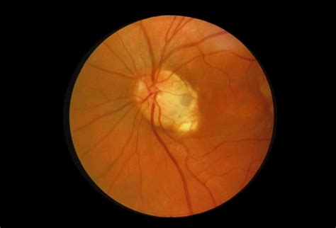 Optic Disc Pit - Retina Image Bank