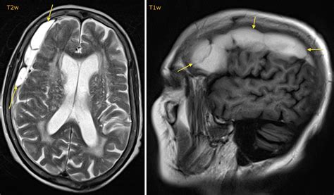 Subacute subdural haematoma - MRI - Radiology at St. Vincent's ...