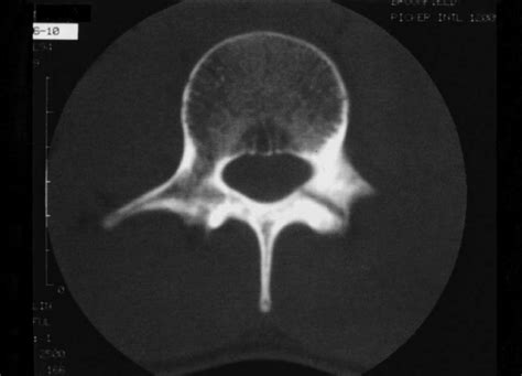 CT scan showing pars interarticularis defect. | Download Scientific Diagram